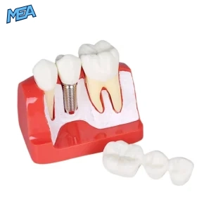 Dental Implant & Crown Bridge Demonstration Model Patient Education Teeth Model (New) - view 2