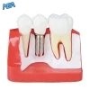 Dental Implant & Crown Bridge Demonstration Model Patient Education Teeth Model (New) 4 Dental implant model cross-section showing implant fixture, crown, and adjacent natural tooth for patient education