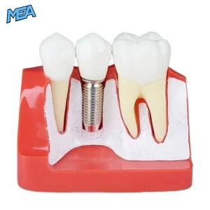 Dental implant model cross-section showing implant fixture, crown, and adjacent natural tooth for patient education