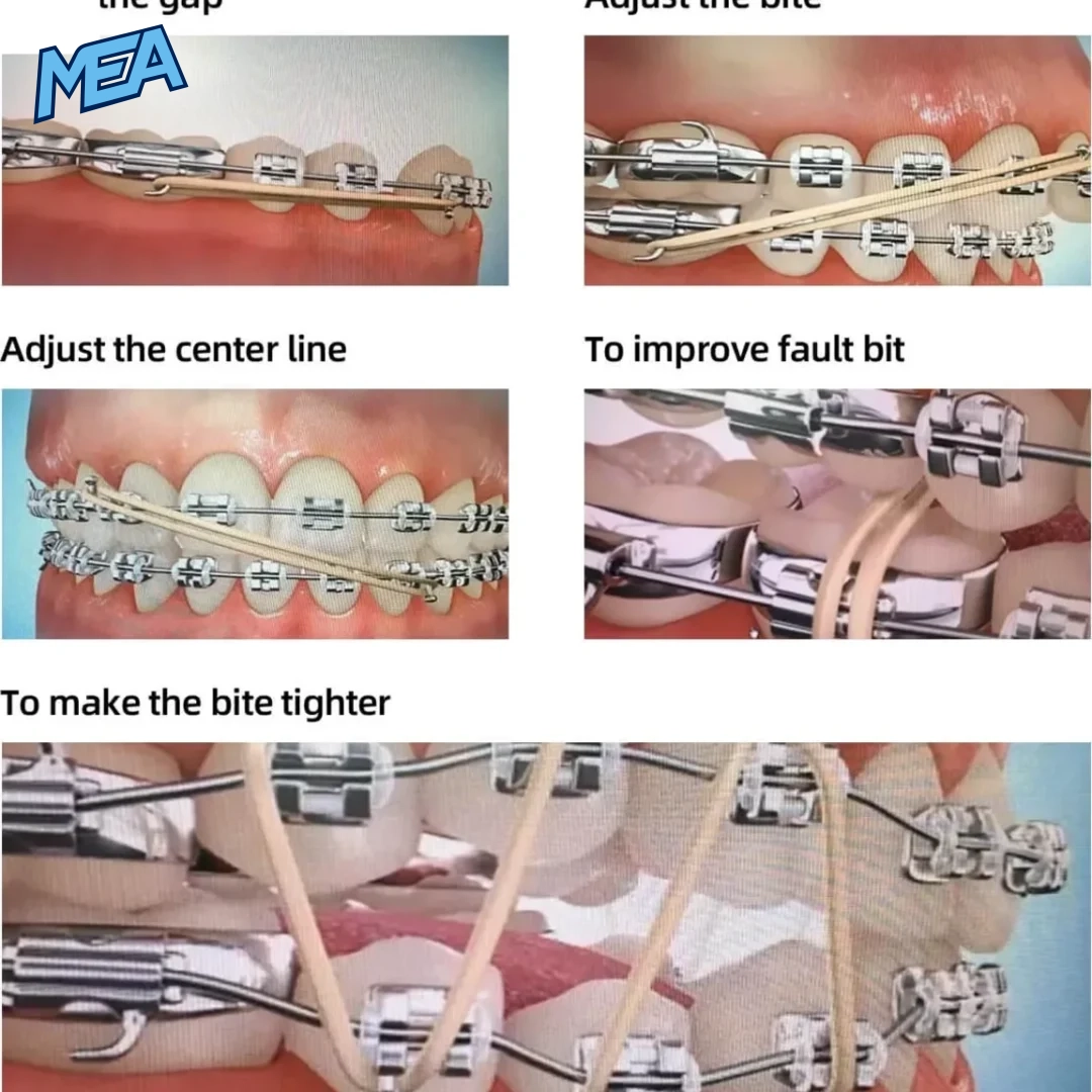 Orthodontic elastics uses for gap closing, bite adjustment and midline correction