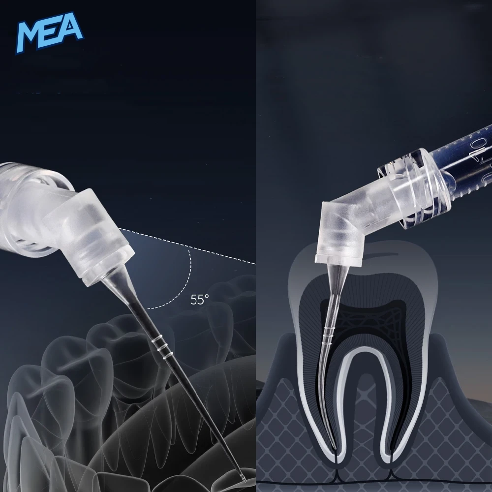 30G Endo Irrigation Needle Tips 0.3mm Side-Vented Root Canal Irrigation Tips (10/20/30 Pcs) 4 Side-vented endo irrigation tip inserted into a root canal showing lateral irrigant flow
